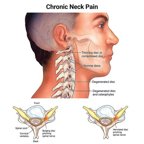 Chronic Neck and Back Pain