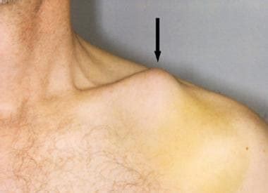 Unveiling the Truth Behind Clavicle Fracture Tenting Skin: A Comprehensive Guide
