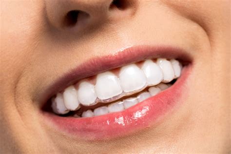 Achieving a Straighter Smile with Clear Aligners in Aurora