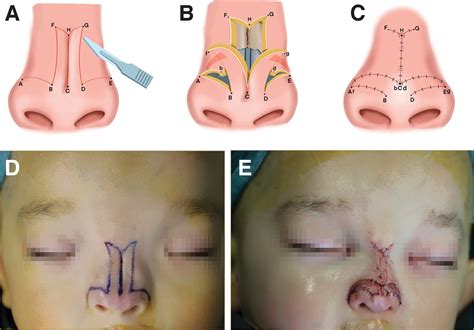 Cleft Nose Repair Overview