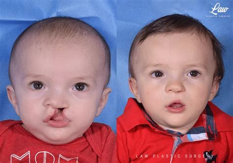 Cleft lip surgery