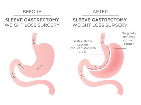 Clinics that offer Gastric Sleeve Surgery in the US