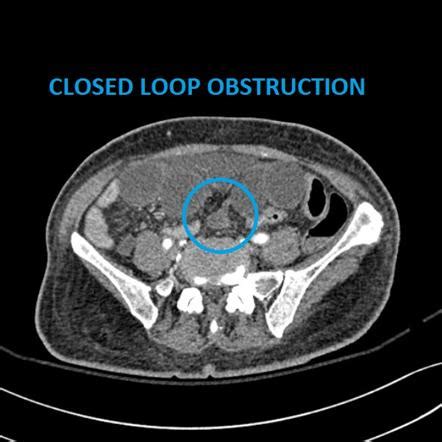 Obstruction Radiology