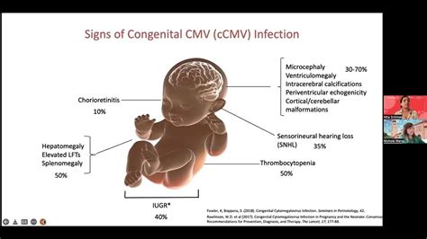 Cmv In Babies