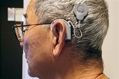 Cochlear Implants: Hear Again, Live Fully.