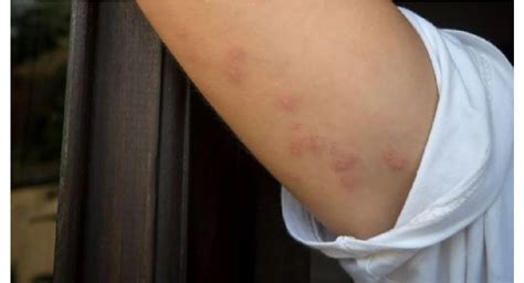 Terrifying Reality: Discover the Shocking Truth About Cockroach Bites On Your Skin