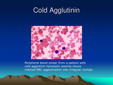 Cold Agglutinin Test and interpretation