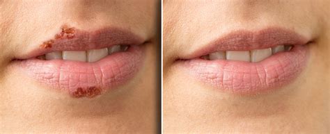 Cold Sores & Mouth Herpes: Symptoms & Treatment