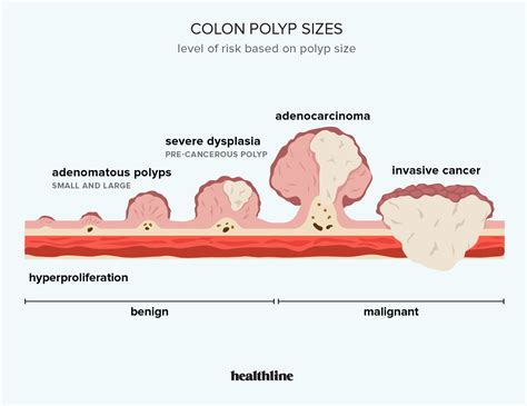 Colon Polyp Size Chart: Understanding The Importance Of Polyp Size In Colorectal Cancer Screening