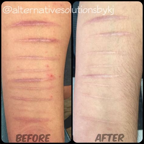 Before and After Color Tattoo Removal YouTube