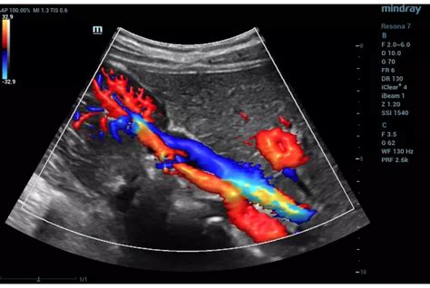 Color Doppler Imaging