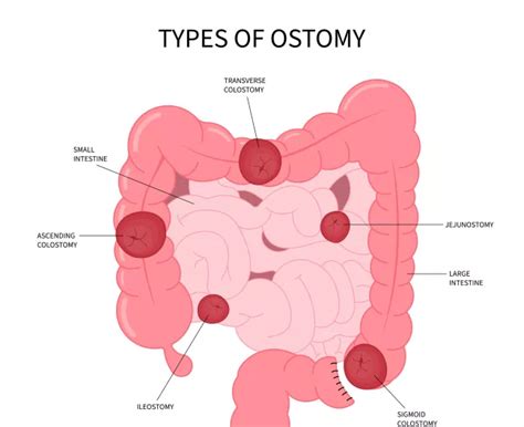 Colostomy: Types, Purpose & Life After Surgery
