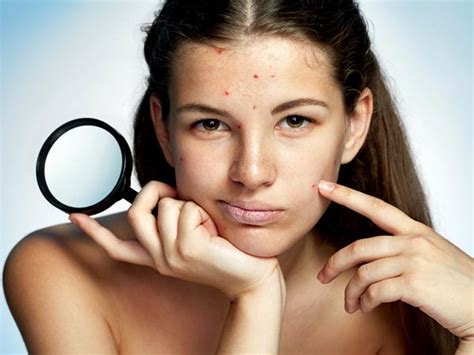 Acne Myths and Truths Acne medications, Acne care, Acne causes