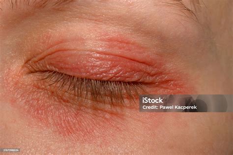 Common Allergy Triggers Causing Under Eye Issues