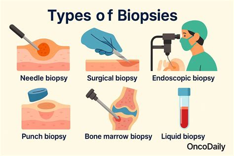 Common Biopsy Types