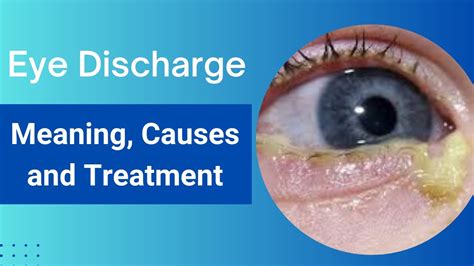 Common Causes of Eye Leaking