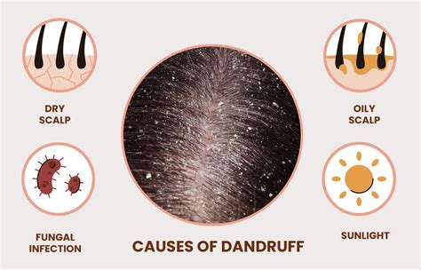 Common Causes of Hair Dandruff