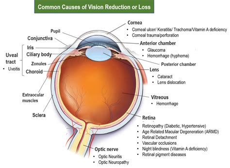 Common Causes of Vision Loss In One Eye