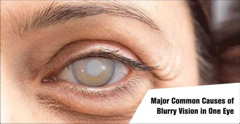 Common Causes of Warped Vision In One Eye