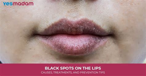 Common Culprits Why Spots Appear Near Your Lips