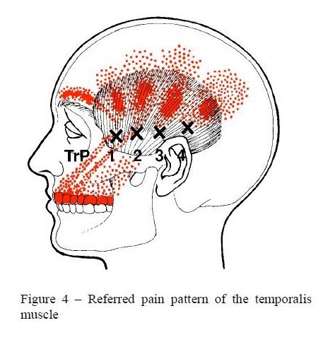 Common Dental Issues That Cause Referred Pain