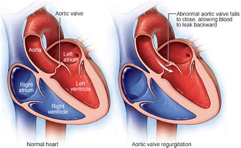 Image depicting the impact of Aortic Regurgitation on heart health