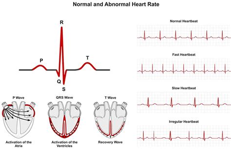 Arrhythmia Diagnosis