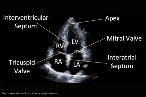 Common Health Issues Echocardiogram