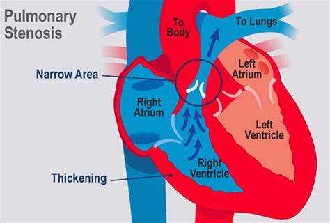 Common Health Issues: Pulmonary Stenosis