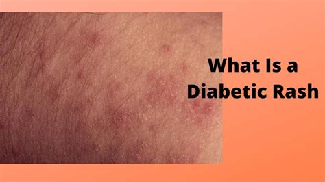 Common Rashes Linked to Diabetes