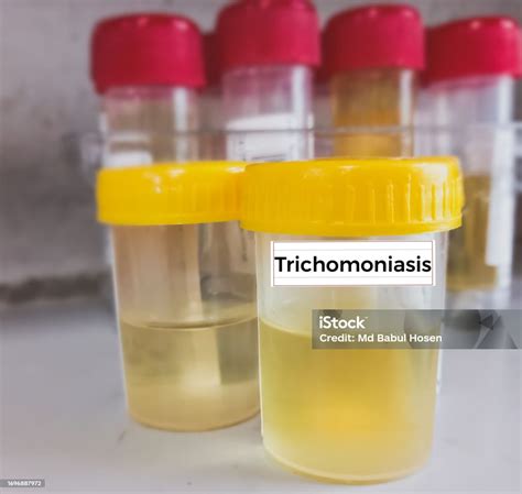 Common STDs Tested in Urine Samples