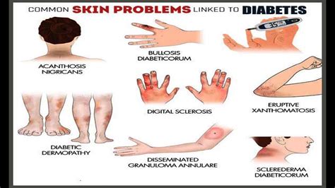 Common Skin Conditions Linked to Diabetes