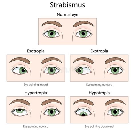 Common Types of Eye Misalignment