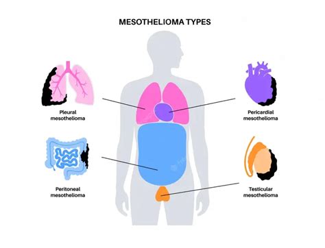 Common Types of Mesothelioma