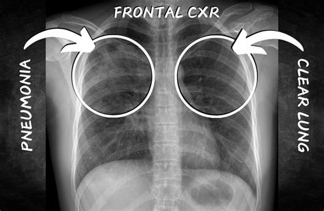 Comparing Frontal and Side View X-rays for Pneumonia