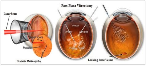 Comparing Laser Treatment to Surgery (Vitrectomy)