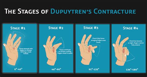 Complete Information on Dupuytren's contracture with Treatment and Prevention