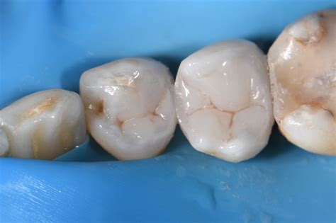 Complex fillings