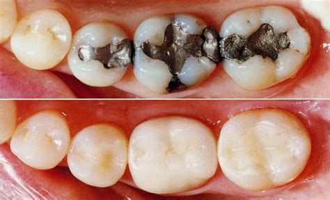 Composite Tooth-Colored Fillings Brush Sooner