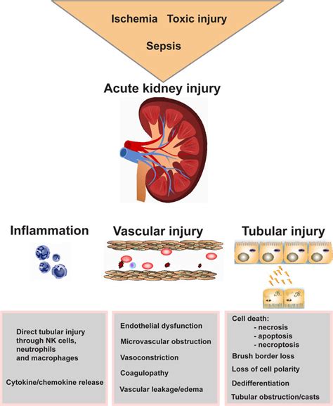 Concept Map For Acute Kidney Injury