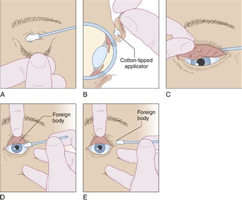 Conjunctiva Foreign Object Removal: Quick & Easy Tips