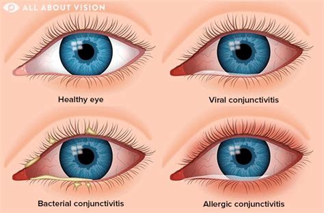 Conjunctivitis: When Allergies Cross the Line