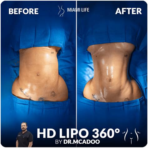 Considering Cosmetic Procedures (Liposuction)