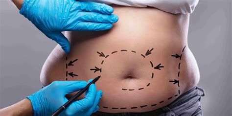 Considering a Tummy Tuck