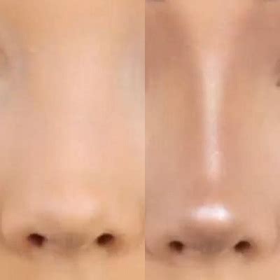 They call it "The Cheapest Nose Job You'll Ever Get" - What Exactly is