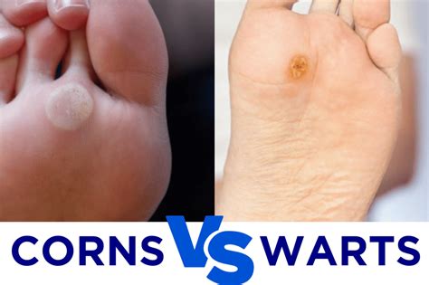 Corns, Warts & Calluses: Effective Treatment Solutions