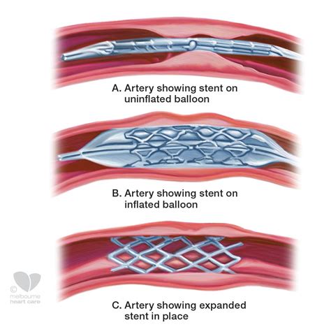 Coronary Artery