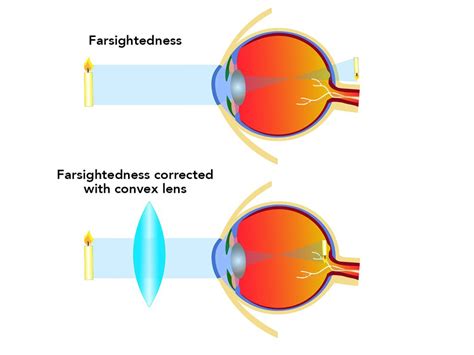 Correcting Farsightedness: Causes & Effective Treatments