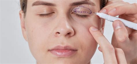 Correcting droopy eyelids