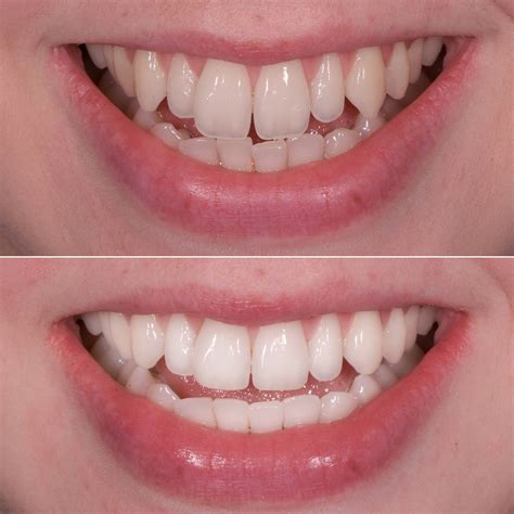 Cosmetic procedures for fixing front teeth